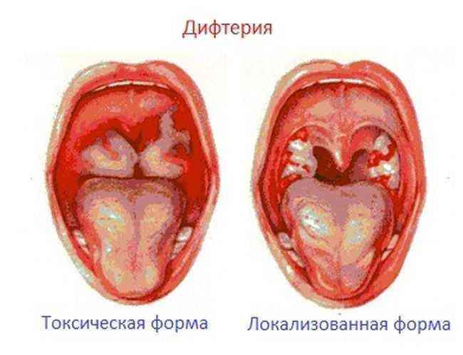 Дифтерия